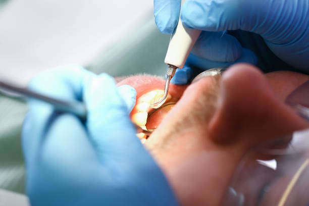 Best Emergency Denture Repair in Foster City, CA